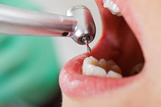 Best Emergency Root Canal Treatment in Fountain, CO